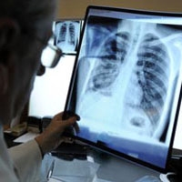 В Украине впервые утвержден унифицированный протокол для лечения туберкулеза