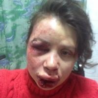 Состояние пострадавшей от избиения журналистки Татьяны Черновол средней степени тяжести