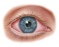 Трахома: глазная инфекция, приводящая к слепоте