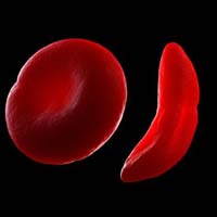 Серповидноклеточная анемия и другие гемоглобинопатии